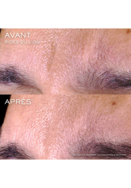 Rénergie Lancôme Triple Sérum Retinol pas cher